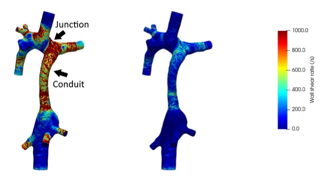 Flow in Fontan circulation.