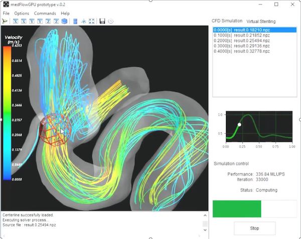 Flow simulation in an aneurysm.