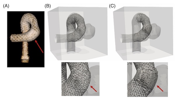 virtual stent deployment.